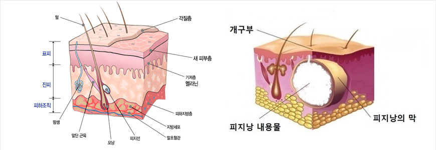 피부단면도와 피지낭종